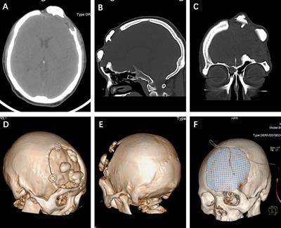 Relapse of skull osteoma after hydroxyapatite cement cranioplasty: Case Report